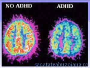 activitate cerebrala adhd