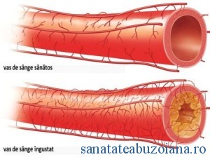 ateroscleroza