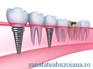 implant-dentar2
