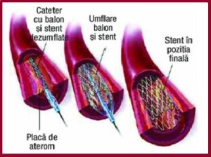 montare-stent-in-infarct-miocardic