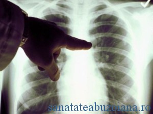 cancer-pulmonar
