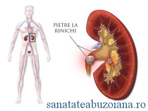 pietre la rinichi litiaza renala