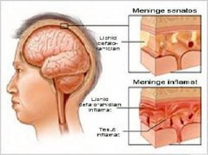 meningita