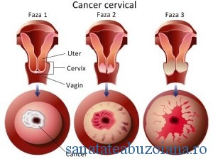 Stadii ale cancerului de col uterin