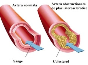 Depunerea-de-colesterol-pe-artere